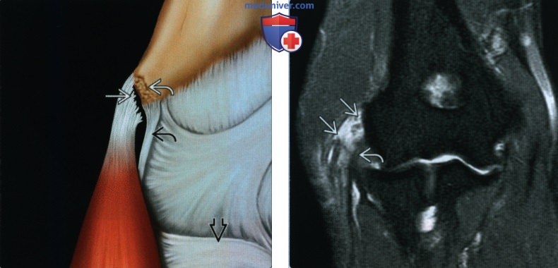 Признаки повреждения сухожилия общего разгибателя на уровне локтевого сустава