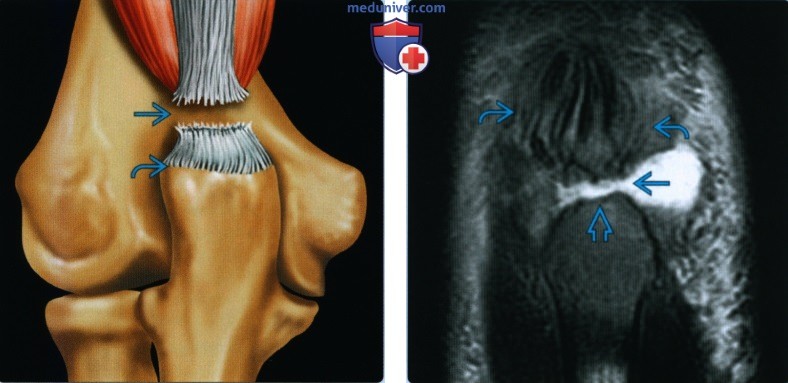 Признаки повреждения сухожилия трехглавой мышцы на уровне локтевого сустава