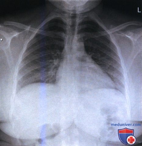 Примеры анализа качества рентгенограмм органов грудной клетки лежа на спине (передне-задней проекции)