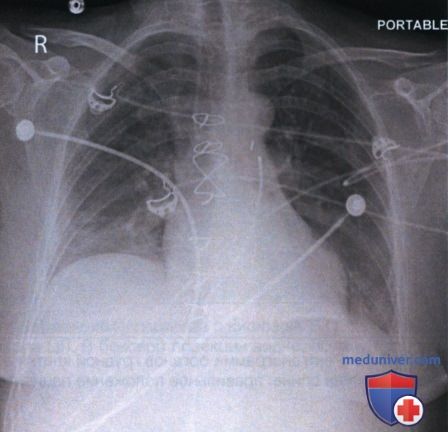 Примеры анализа качества рентгенограмм органов грудной клетки лежа на спине (передне-задней проекции)