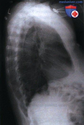 Примеры анализа качества рентгенограмм органов грудной клетки в боковой проекции (левой)