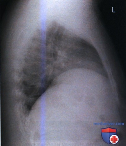 Примеры анализа качества рентгенограмм органов грудной клетки в боковой проекции (левой)