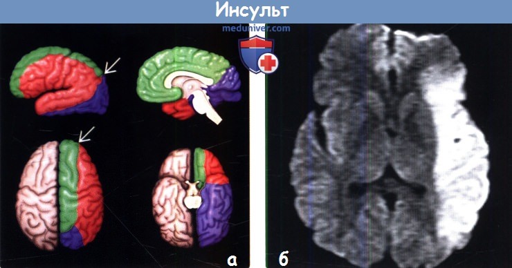 Пример МРТ при инсульте