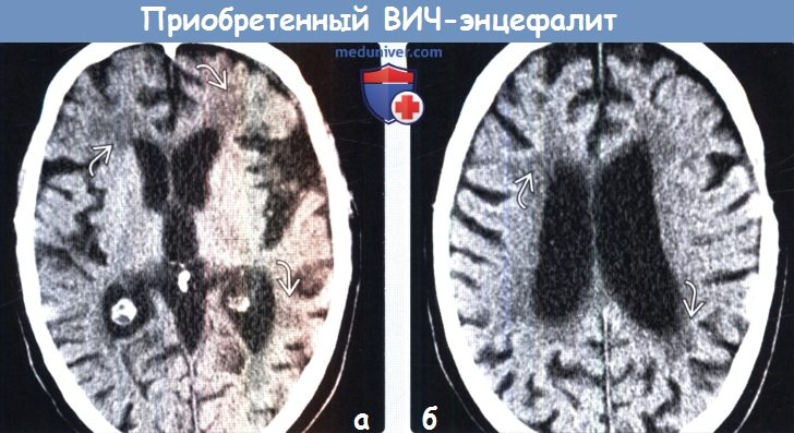Лейкоэнцефалопатия головного мозга на мрт thumbnail