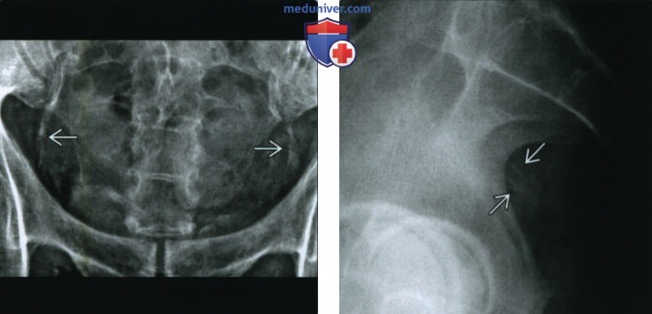 Костно-мышечная система при избытке и недостатке фтора - лучевые признаки