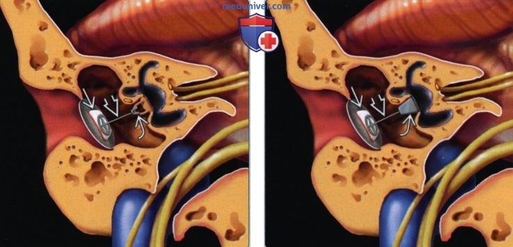 Протезы слуховых косточек - лучевая диагностика