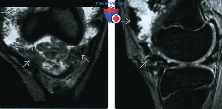 Пигментный ворсинчато-узелковый синовит (ПВУС) - лучевая диагностика