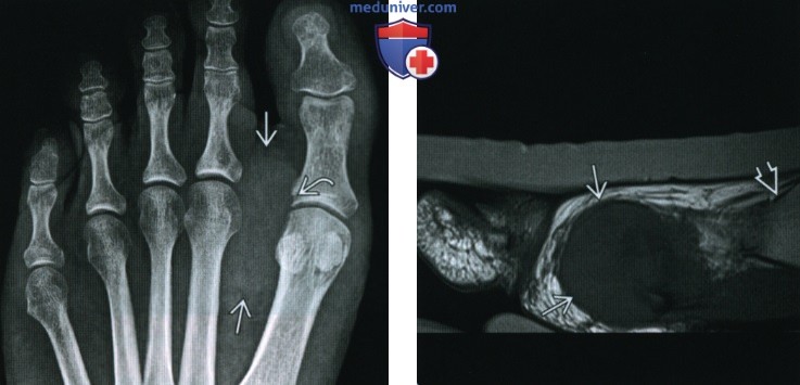 Ревматоидный артрит голеностопного сустава и стопы - лучевая диагностика