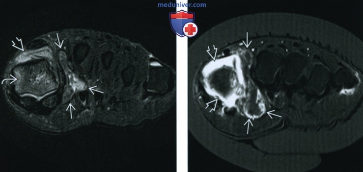 Ревматоидный артрит голеностопного сустава и стопы - лучевая диагностика