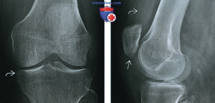 Ревматоидный артрит коленного сустава - лучевая диагностика