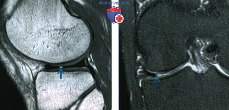 Признаки радиального разрыва мениска коленного сустава