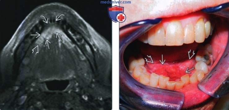 Плоскоклеточный рак дна полости рта - лучевая диагностика
