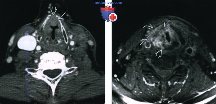 Плоскоклеточный рак гортани - лучевая диагностика