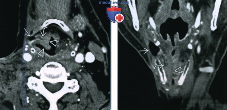 Плоскоклеточный рак гортани с ларингоцеле - лучевая диагностика