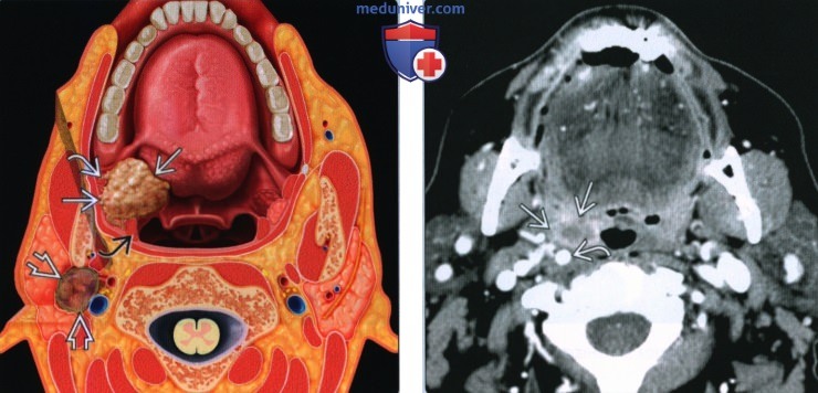 Плоскоклеточный рак небной миндалины - лучевая диагностика