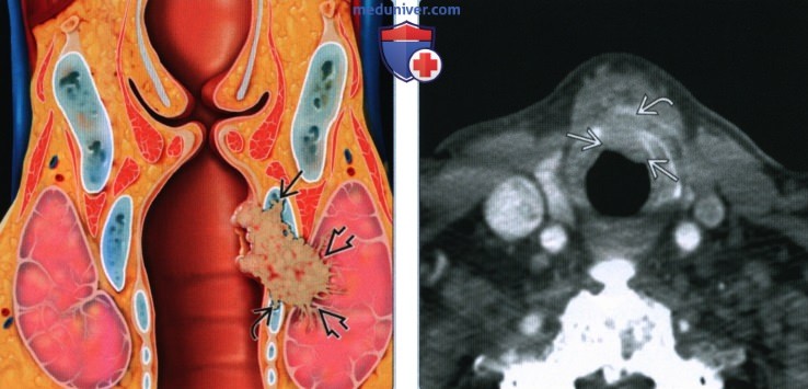 Плоскоклеточный рак подсвязочного отдела гортани - лучевая диагностика