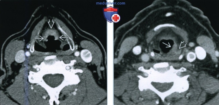 Плоскоклеточный рак преддверия гортани - лучевая диагностика