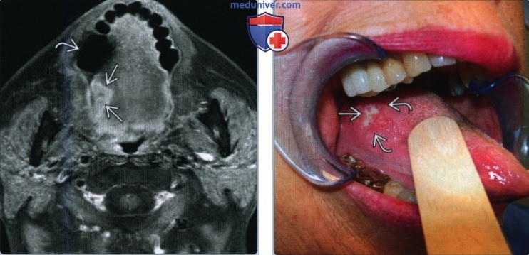 Плоскоклеточный рак тела и верхушки языка - лучевая диагностика