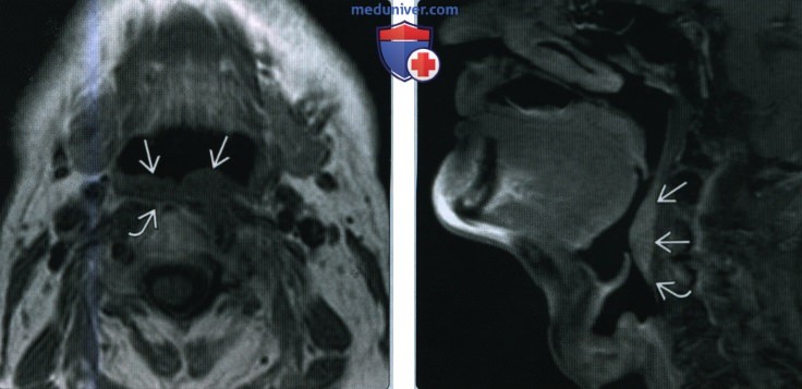Плоскоклеточный рак задней стенки ротоглотки - лучевая диагностика