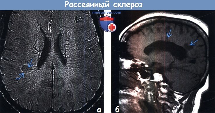 Рассеянный склероз на МРТ