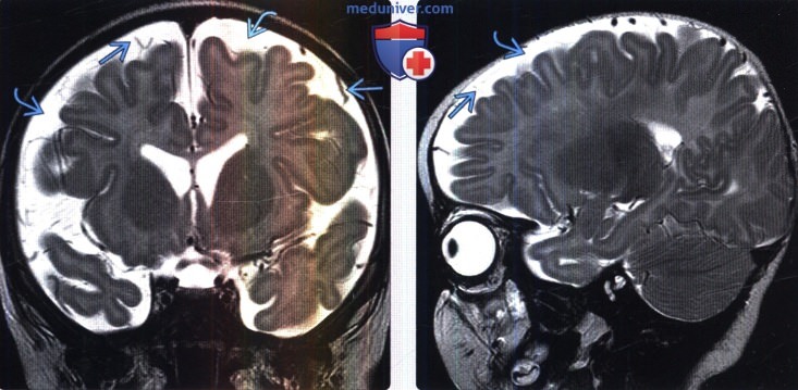 Расширение субарахноидальных пространств на МРТ головного мозга