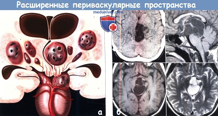 Расширенные периваскулярные пространства головного мозга на КТ, МРТ