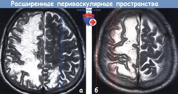 Расширенные периваскулярные пространства головного мозга на МРТ