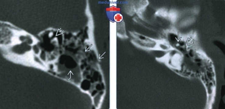 Разрывы цепи и вывихи слуховых косточек - лучевая диагностика