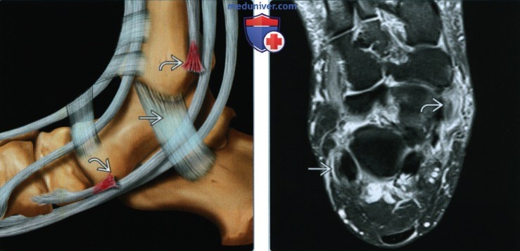Признаки разрыва или тендинопатии сухожилия задней большеберцовой мышцы
