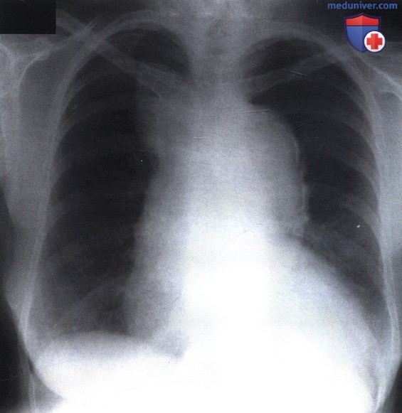Рентгенограмма с патологическим затемнением в области средостения и увеличенной тенью сердца при аневризме аорты
