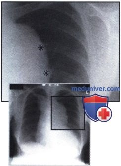 Рентгенограмма с патологическим затемнением в области средостения и увеличенной тенью сердца при аневризме аорты
