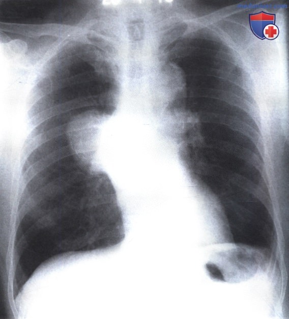 Рентгенограмма с патологическим изменением корня правого легкого при аневризме аорты