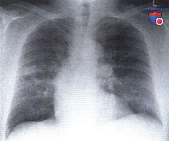 Рентгенограмма с затемнением в обоих легких при антракозе