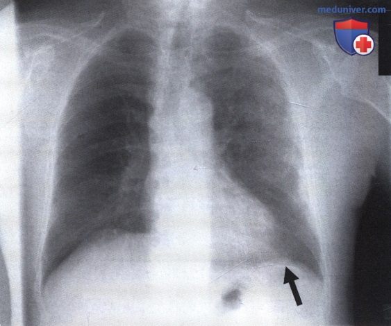 Рентгеновский снимок с очаговыми тенями в легком при асбестозе