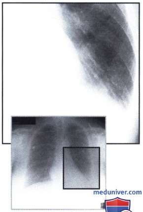 Рентгенограмма с изменением диафрагмы слева при ателектазе