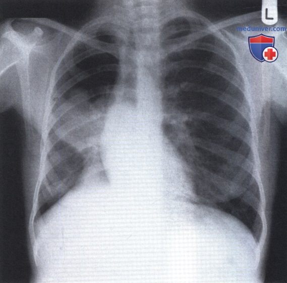Рентгенограмма с затемнением в среднем отделе правого легочного поля при ателектазе нижней доли