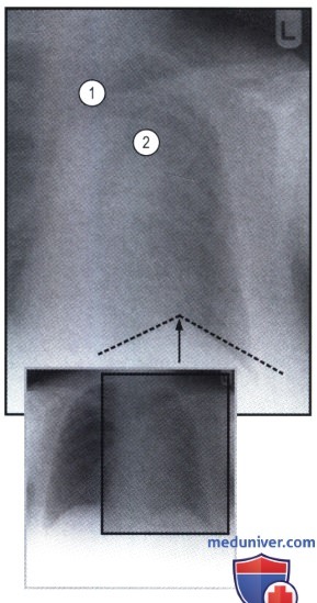 Рентгенограмма с затемнением левого легочного поля и патологией средостения при ателектазе