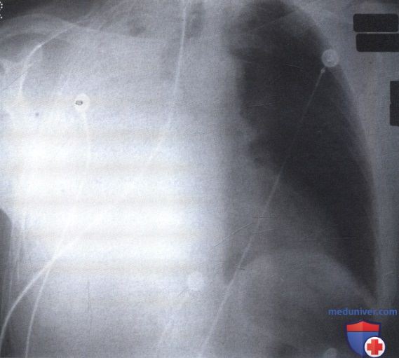 Рентгеновский снимок с затемнением правого легочного поля при ателектазе