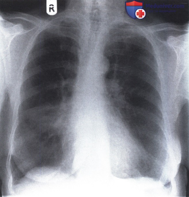 Рентгеновский снимок с затемнением правого легкого при ателектазе средней доли