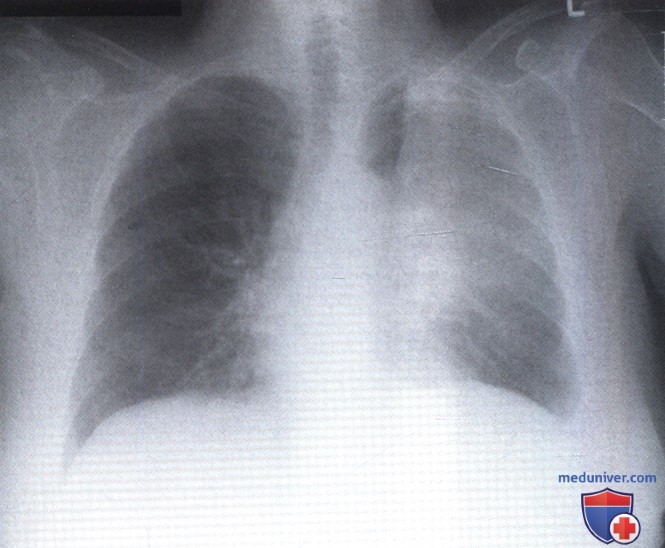 Рентгенограмма с ателектазом верхней доли левого легкого при раке