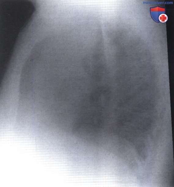 Рентгенограмма с участком повышенной плотности при ателектазе верхней доли левого легкого