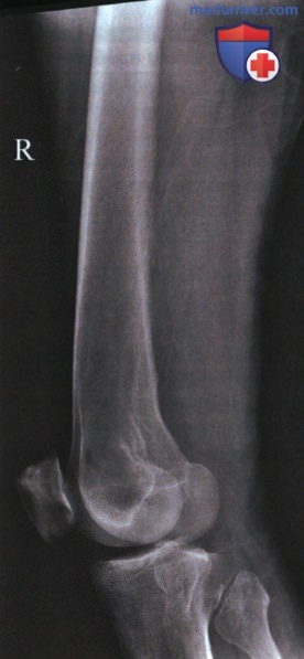 Рентгенограмма дистального отдела бедренной кости в боковой проекции