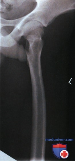 Укладка при рентгенограмме проксимального отдела бедренной кости в боковой проекции