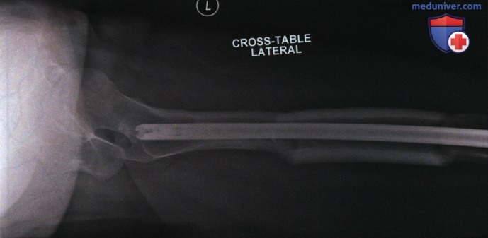 Рентгенограмма проксимального отдела бедренной кости в боковой проекции