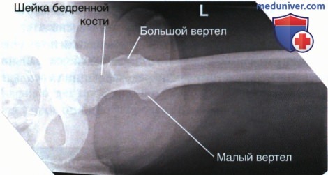 Рентгенограмма проксимального отдела бедренной кости в боковой проекции