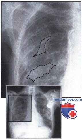 Рентгеновский снимок с множественными затемнениями в обоих легочных полях при плевральных бляшках