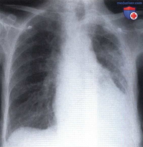 Рентгенограмма с затемнением обоих легочных полей при бронхоэктазах