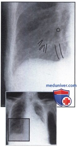 Рентгенограмма с затемнением обоих легочных полей при бронхоэктазах