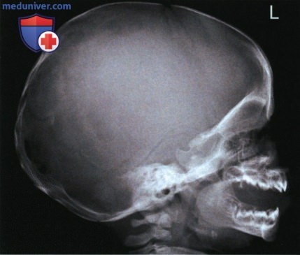 Укладка при рентгенограмме лицевого отдела черепа, придаточных пазух и костей носа в боковой проекции