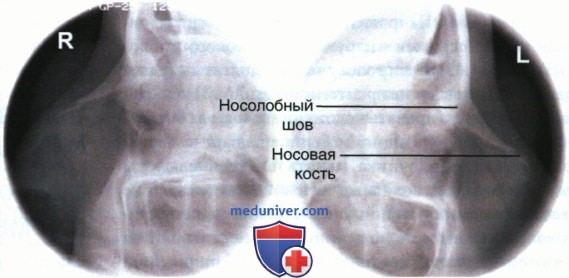 Рентгенограмма лицевого отдела черепа, придаточных пазух и костей носа в боковой проекции